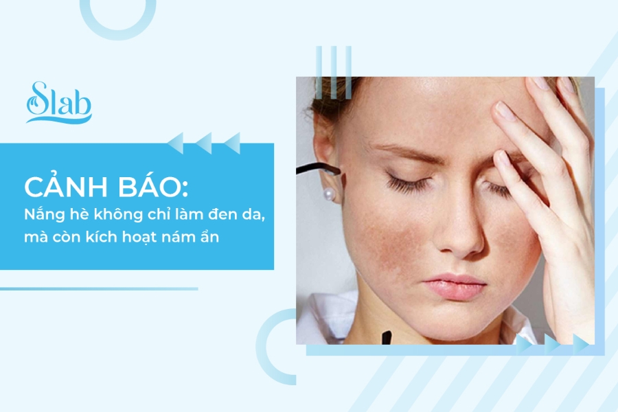 CẢNH BÁO: Nắng hè kích hoạt nám ẩn